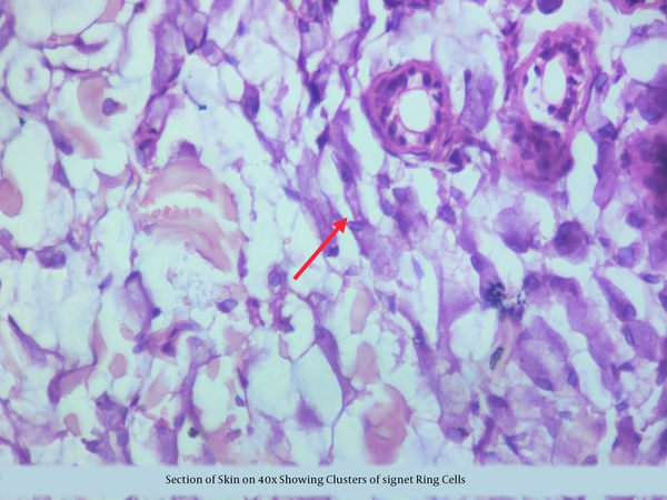 A skin section at 40x, presenting clusters of signet ring cells surrounding sweat and sebaceous glands