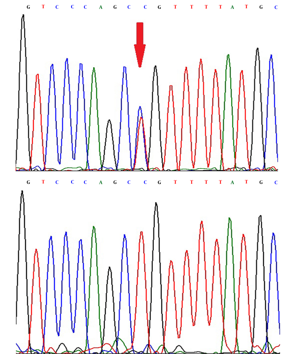 Sequence Electropherogram of the rs2234693 in the ESR1 Gene. The arrow in the above electrophoretogram revealed base substitution T&gt;C heterozygote in a sample, and homozygote TT is shown below.