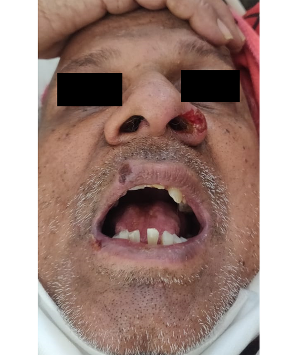 The ulcer (1 cm × 1 cm) with irregular margins and tissue red granulation on the left ala with crusted erosions over the right side of the upper lip and the corner of the mouth