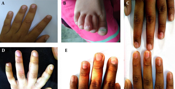 Nail changes following Hand foot-mouth disease (HFMD). A, A 15-month-old female with right upper limb nails showing onychomadesis and Beau’s lines; B, An 18-month-old male with great toenail with onychomadesis; C, A 54-month-old male with onychomadesis in both upper limb nails; D, A 24- month-old female with nail plate break in upper limb; E, A 60-month-old male with onychomadesis.