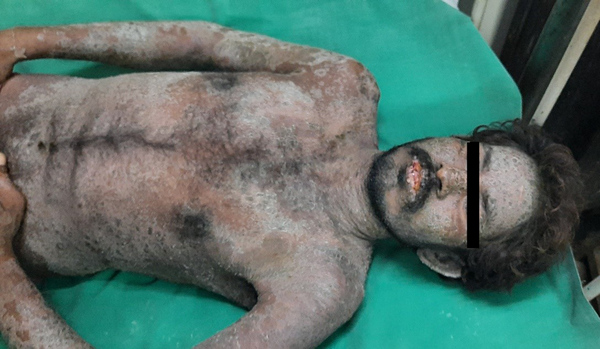Clinical photograph of case 1 on admission, showing exfoliating, erythematous, maculopapular rash over face, upper limbs, and trunk. Erosions with crusting present over lips.