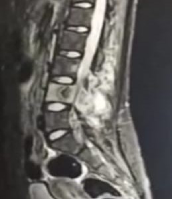 Sagittal magnetic resonance imaging (MRI) of spine showing the 4th lumbar vertebral sclerosis