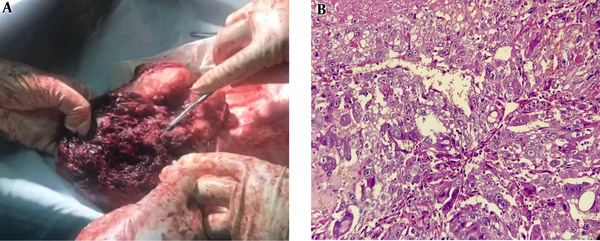 A: About a 9 × 8 cm lesion with invasion to the uterus wall and cervix. B: The tumor shows a mixture of cytotrophoblasts, intermediate trophoblasts, and syncytiotrophoblast with atypical nuclei and prominent nucleoli invading the myometrium, H&E, X400.