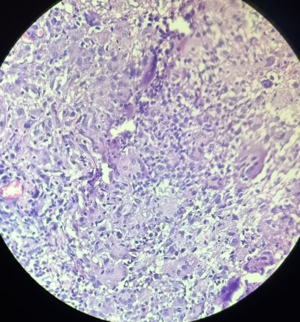 Skin biopsy (H & E, 40X). Foci of epitheloid cell granulomas and Langhans’ giant cells