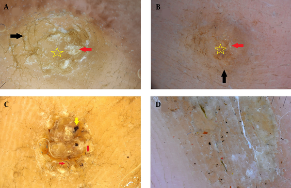 Dermoscopic image of callus (A) and (B) shows opaque yellow area (yellow star) with focal white areas (red arrow) with preserved dermatoglyphics (black arrows) [Illuco 1100 IDS, Polarized, 10×]. C, Dermoscopic image of plantar wart shows globular vessels (yellow arrow) and adherent fabric fibres (red arrows). D, Dermoscopy of callus shows red, black, and brown dots, which are referred to as pseudo hemorrhagic structures [Illuco 1100 IDS, Polarized, 10×].