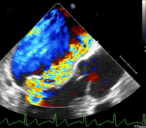 Severe anterior directed mitral regurgitation in trans-esophageal echocardiography
