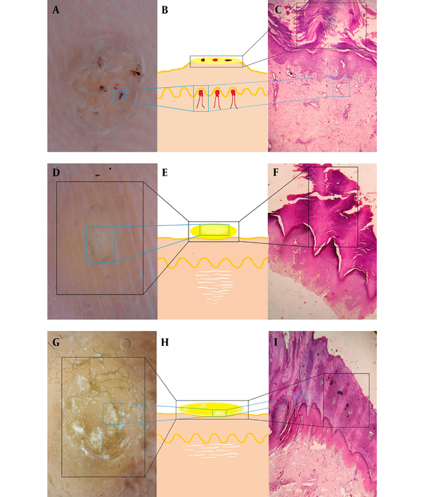 Schematic diagram showing a dermoscopic and histopathological correlation in plantar wart (A, B & C). Schematic diagram showing a dermoscopic and histopathological correlation in corn (D, E & F). Schematic diagram showing a dermoscopic and histopathological correlation in callus (G, H & I).