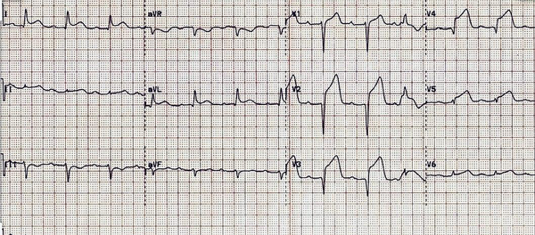 ECG showing ST elevation in V1-V6 and reciprocal changes in the inferior leads.