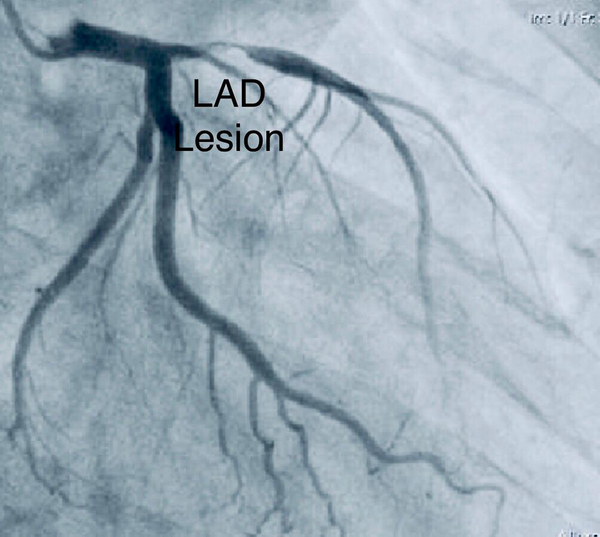Left anterior descending artery, with significant proximal lesion in angiography.