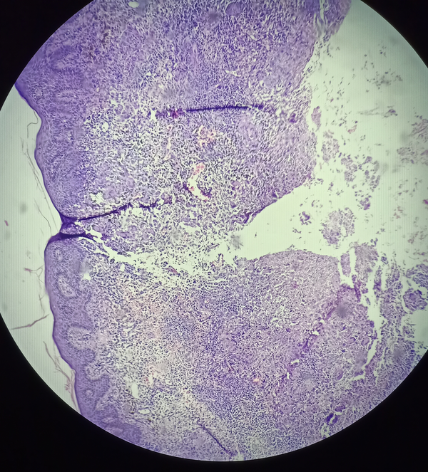 Skin biopsy (H & E, 10X). Foci of caseous necrosis, epithelioid cell granulomas, and Langhans’ giant cells