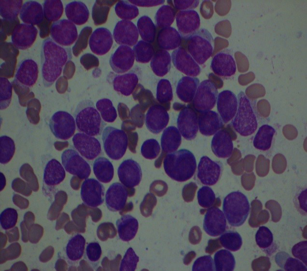Patient's bone marrow smear at the time of diagnosis shows that more than 70% of nucleated cells are blast.