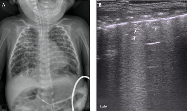Air Vesicle Signs (AVS). LUS findings in an oxygen-dependent extremely premature infant with a gestational age of 28 weeks at four months of birth. CXR showed honeycomb lucency suggesting pulmonary vesicle formation (A). LUS showed pleural line thickening and fuzzy, scattered dot or linear hyperechoic reflection (arrow) is seen within the lung field, which is AVS (B).