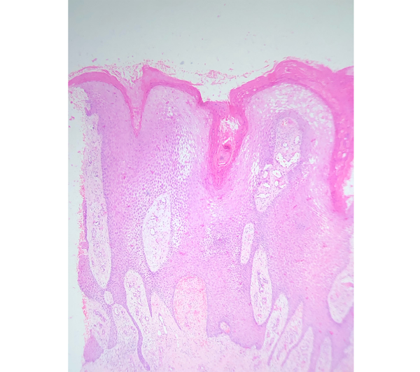 H&E, 4X magnification with hyper and parakeratosis, pseudoepitheliomatous hyperplasia, and dermal infiltrate