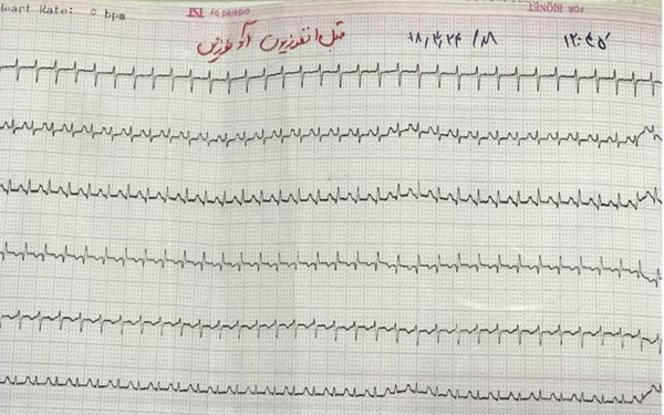 At 18 hours of birth, the HR was 230-240 beats/min which confirmed the SVT; AVNRT rhythm.