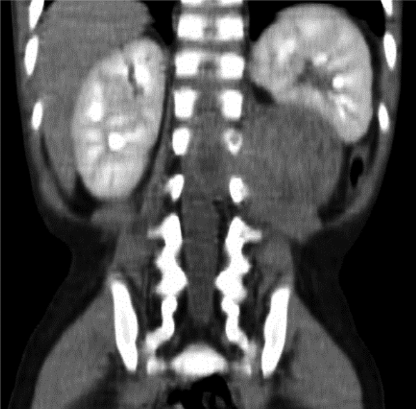 A large paraspinal heterogeneous tumor with extension into the spinal column and spinal cord compression in computed tomography scan.