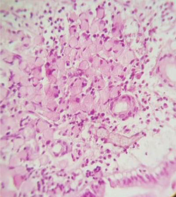 PDF] Endoscopic features of early-stage signet-ring-cell carcinoma of the  stomach by Chainarong Phalanusitthepha, Kevin L. Grimes, Haruo Ikeda,  Hiroki Sato, Chiaki Sato, Chananya Hokierti, Haruhiro Inoue ·  10.4253/wjge.v7.i7.741 · OA.mg