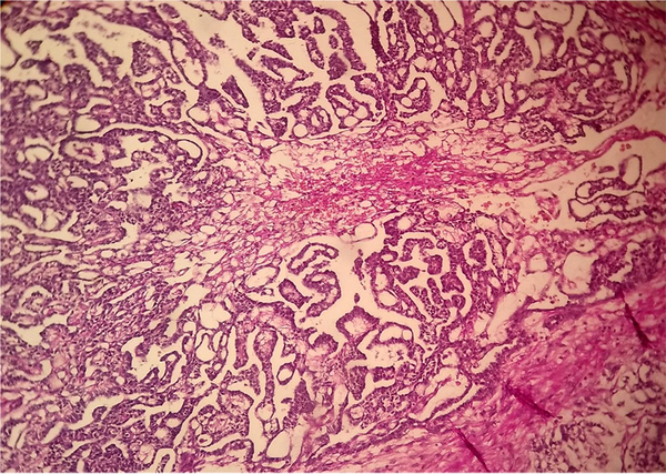 Pseudo glandular and trabecular structures and microcystic reticular pattern in favor of yolk sac tumor.