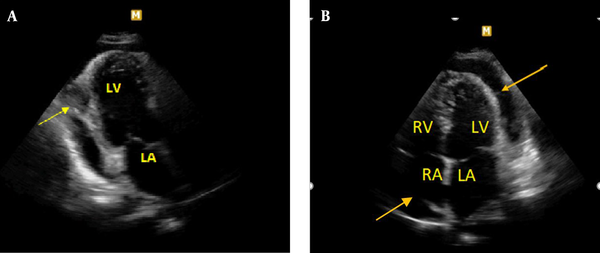 Moderate size pericardial effusion resulted in cardiac tamponade with a round cystic lesion suspected to hydatid cyst . A, Arrow indicates to the cystic lesion posterior to LV (left ventricle). B, Arrows indicate to circumferential pericardial effusion. LV: left ventricle, RV: right ventricle, LA: left atrium, RA: right atrium.