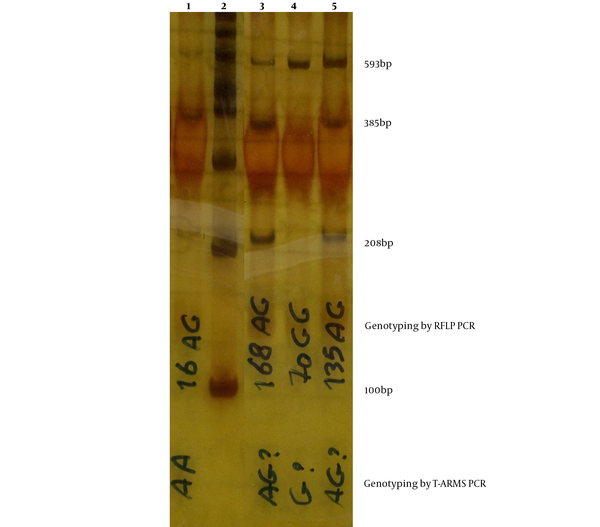 Genotyping of rs2987983 polymorphism by RFLP-PCR. Lines 1, 3, and 5 have been confirmed as AG genotype, and line 4 has GG genotype. Line 2 has a 100pb size marker.
