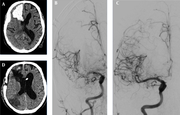 A, initial cCT depicts right frontal ICH with subdural hematoma; B, in the course of hospital stay, cerebral vasospasm occurred on the 13th postoperative day (angiogram p.a.-projection of right ICA injection); C, after four times of PTA and local spasmolysis, vasospams of the ACA and MCA-territories resolved; D, final cCT after vp-shunt implantation revealed partial infarction of the right posterior MCA-territory.