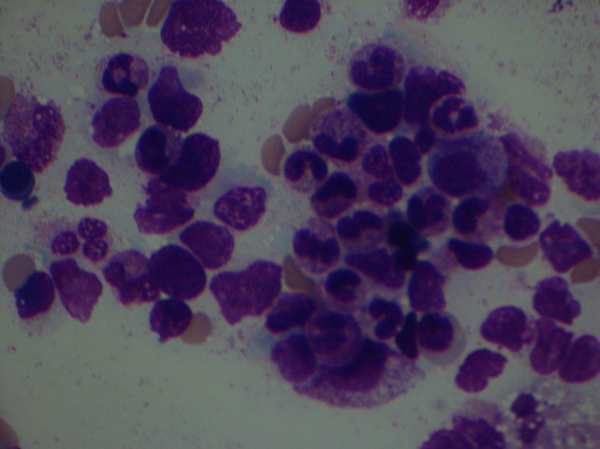 Bone marrow smears of the patient on the twelfth day after chemotherapy show regenerative marrow and less than 5% blast.