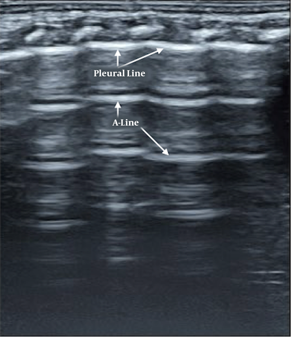 Normal lung ultrasound manifestation. Pleural lines and A-lines are smooth, regular, and straight hyperechoic lines, parallel and equidistant from each other. A-lines gradually diminish and finally disappear off the screen, which formed a manifestation of bamboo-like, named as “bamboo sign”.