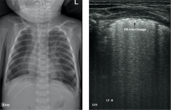 Pleural line insect erosion (PIE)-like change. LUS findings of pneumonia demonstrated in an oxygen-dependent extremely premature infant with a gestational age of 27 weeks at 102 days of birth. CXR showed bilateral lung texture increased, fuzzy and disorder, coarse interstitial opacification, especially the inner band of double lung fields, which is consistent with pulmonary tis-sue fibrosis. LUS shows the pleural line thickening, fuzzy, PIE-like change, and AIS, which is consistent with pulmonary fibrosis.