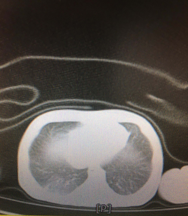 Spiral thorax computed tomography scan without contrast with ground-glass opacities in the right lung suggestive of SARS-CoV-2 pneumonia