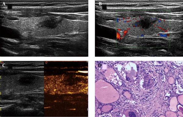 A thyroid imaging reporting &amp; data system (TI-RADS) 4c asymptomatic subacute thyroiditis (aSAT) nodule in a 52-year-old woman. A, Conventional two-dimensional image. B, Color Doppler image. C, Contrast-enhanced ultrasonography (CEUS) image indicates hypoenhancement. D, The pathological examination reveals symptomatic subacute thyroiditis (SAT) (H&amp;E staining, × 100).