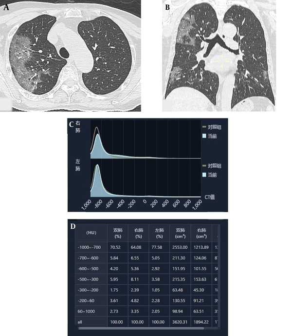 AI-based quantitative chest CT analysis of a patient with COVID-19. A, Axial CT image; B, Coronal CT image; C, Histogram of total lung density; and D, Distribution table of total lung volume (AI, artificial intelligence; COVID-19, Coronavirus disease 2019).