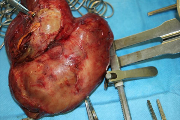 Renal mass after resection
