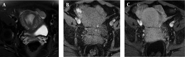 The MRI findings of a 55-year-old patient with the chief complaints of heavy, prolonged menstrual bleeding and a persistently abnormal yellow discharge. The definitive histopathological diagnosis was high-grade serous carcinoma of the left fallopian tube. A, T2-weighted image shows a tubular, slightly low-signal structure in the left adnexa, separated from the left ovary. B, This tubular structure shows iso-signals in the T1-weighted image with only a thick wall enhancement pattern in the post-contrast image. C, There is no obvious solid component enhancement.