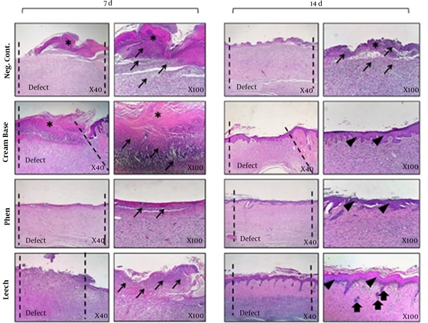 Histopathological analysis (H &amp; E stained microscopic sections) of skin wounds in in vivo wound healing model. This study was conducted on rat. Skin samples of 4 treated groups (negative control, cream base, phenytoin and leech) were collected at day 7 and day 14 for histopathological analysis. Epitheliogenesis and angiogenesis of experimental groups were investigated. Leech-treated collection indicated the best outcomes compared to the other collections. Asteroid sign (*): hard skin, thick arrows (↑): Renovation of skin appendages, thin arrows (→): increasing of corruptive cells, Arrowhead (▲): regeneration of epidermal stratum (re-epithelialization).