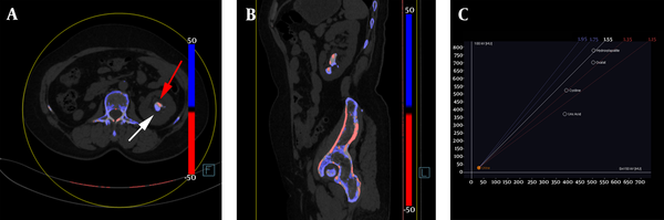The color-coded dual-source dual-energy computed tomography (DSDECT) image showing an example of mixed renal hydroxyapatite (HA)-calcium oxalate (CaOx) stone. A, The HA part is color-coded in blue (white arrow), and the CaOx part is color-coded in red (red arrow) in the axial image of mixed stone; B, Sagittal image of the mixed stone; C, The setting dialog of DSDECT with a ratio value of 1.55.
