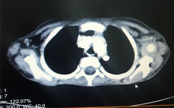 Spiral CT scan of the thorax with IV contrast showed 2 parenchymal nodules measuring 14 mm and 6 mm in left upper lobe (metastasis) and large heterogeneous hemorrhagic mass in sub diaphragmatic area.