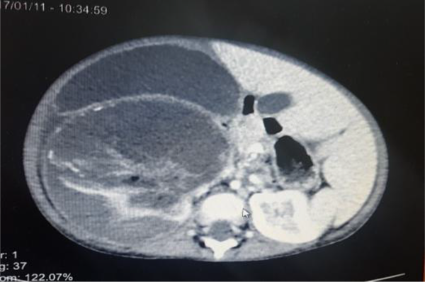 Abdomino pelvic spiral CT scan with IV Contrast showed the heterogeneous masses measuring 168 × 87 × 132 mm with internal hypodense that suggested hemorrhage or necrosis.