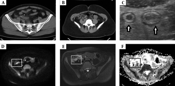 A, A 54-year-old male patient is diagnosed with acute appendicitis surgically. Non-enhanced computed tomography (NECT) shows an enlarged appendix with intraluminal appendicolith (upward arrow) and the surrounding inflamed fatty tissue planes (downward arrow). B, A 23-year-old female patient with acute appendicitis. NECT shows an enlarged and inflamed appendix (arrows). C, An 11-year-old girl with acute appendicitis. Due to tortuosity, the appendix appears to be pseudoreplicated. The US image shows the distending appendix; the arrows represent the appendix. D, Diffusion-weighted magnetic resonance imaging (DW-MRI) shows marked hyperintensity of the appendix with restricted diffusion; the arrow represents the appendix. E, The axial fat-saturated T2W image shows the distending appendix. F, The apparent diffusion coefficient (ADC) image shows marked hypointensity of the appendix with restricted diffusion.
