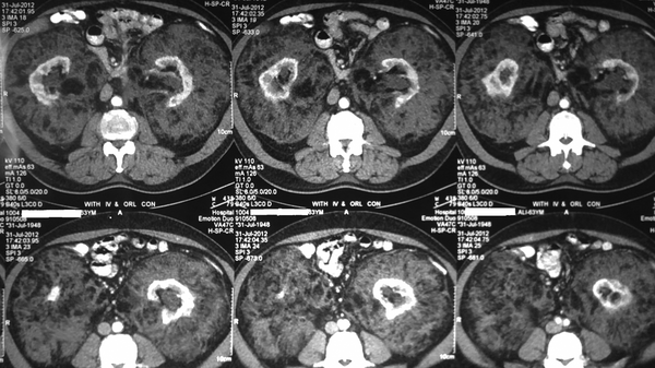 Bilateral perirenal tumor in multiple CT scan cuts