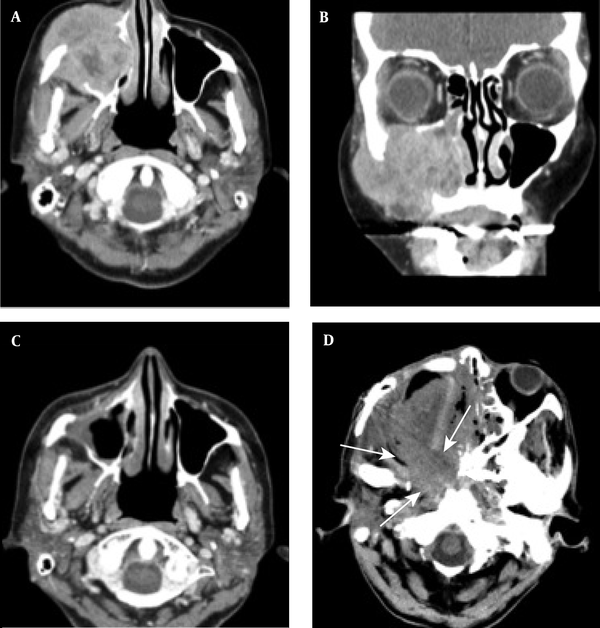 A case of locally advanced maxillary sinus carcinoma treated with chemoradiotherapy followed by surgery. A, Axial contrast-enhanced CT scan shows a large mass in the maxillary sinus on the right side, invading into the subcutaneous tissue. B, Coronal contrast-enhanced CT scan shows tumor invasion into the orbital space on the right side. C, Axial contrast-enhanced CT scan shows tumor remission. D, Axial contrast-enhanced CT scan indicates tumor recurrence (arrows). The patient received the best supportive care, but expired due to tumor progression.