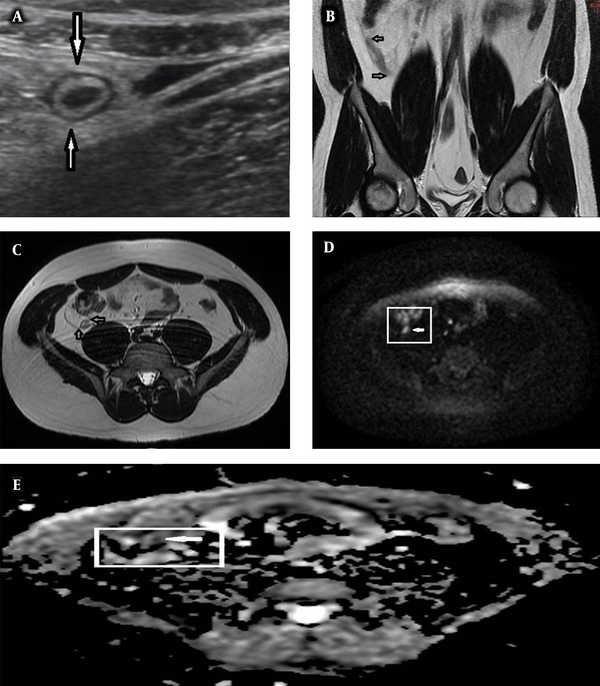 A, A 27-year-old male with acute appendicitis. The US image shows the thick-walled inflamed appendix (arrows). B, Coronal turbo spin echo (TSE) T2W image shows the thick-walled inflamed appendix (arrows). C, Axial TSE T2W image shows the thick-walled appendix and periappendicular fat stranding (arrows). D, Diffusion-weighted magnetic resonance imaging (DW-MRI) shows marked hyperintensity of the appendix with restricted diffusion (arrow). E, The apparent diffusion coefficient (ADC) image shows marked hypointensity of the appendix with restricted diffusion (arrow).
