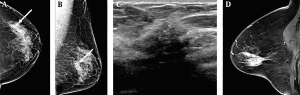 A 78-year-old woman visited our hospital due to abnormal mammographic findings. A and B, The breast composition on mammography (MG) was heterogeneously dense. The left craniocaudal and mediolateral oblique views showed grouped microcalcifications in the left outer central deep region of the breast (white arrows); C, The anti-radial ultrasound revealed an irregular hypoechoic mass with spiculated margins and microcalcifications; D, Contrast-enhanced sagittal breast MRI showed a regional heterogeneous non-mass enhancement in the left central portion of the breast. The patient underwent a modified radical mastectomy, and the lesion was confirmed as invasive ductal carcinoma (IDC) and ductal carcinoma in situ (DCIS). The pathological size of the lesion was 3 cm. The lesion size was measured to be 1.1, 1.7, and 3.5 cm on MG, ultrasound, and breast MRI, respectively.