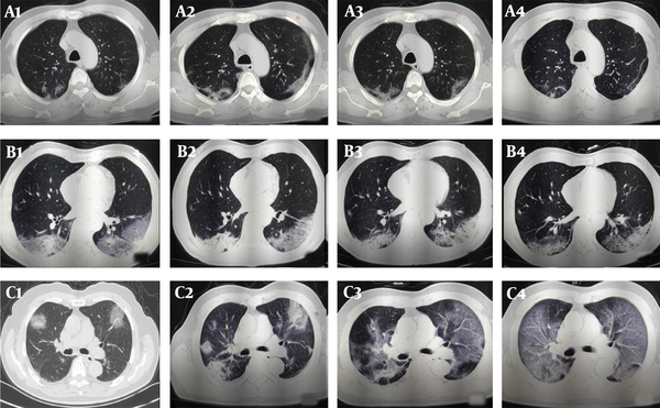 The follow-up CT scans of COVID-19 patients with different clinical outcomes. A, A 57-year-old male patient with good outcomes. The follow-up CT scans show that the extent of lung lesions increased from the third day after the onset of symptoms (day 3; A1) until day 9 (A2), followed by a continuous improvement on day 13 (A3) and day 21 (A4); B, A 57-year-old man with good outcomes. The follow-up CT scans show no obvious change in the extent of lung lesions on the second day after the onset of symptoms (day 2; B1), on day 8 (B2), on day 15 (B3), and on day 18 (B4); C, A 71-year-old male patient with poor outcomes. The follow-up CT scans show the extent of lung lesions continuously increasing on the second day after the onset of symptoms (day 2, C1; day 7, C2; day 13, C3; and day 18, C4).