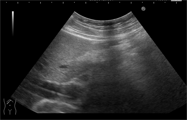 An oblique abdominal ultrasound (US) scan showing a dilated common bile duct (CBD) with the placement of guide wire before stent insertion.