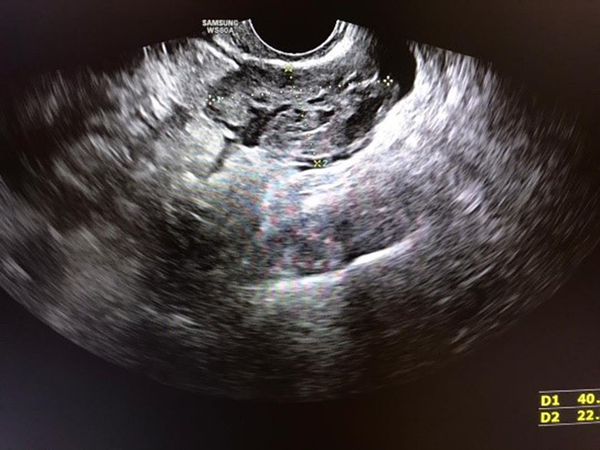 Ultrasound findings showing a 40 × 22 mm isoechoic irregular-shaped lesion in the left adnexa mimicking a clot