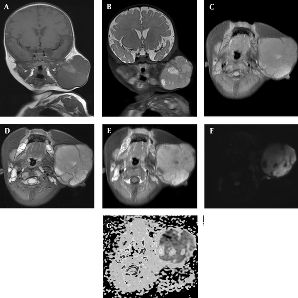 Contrast-enhanced MRI of the neck indicates a well-circumscribed lesion with hypointense septations in the left maxillofacial region. A and C, On coronal and axial T1-weighted images, tumor is isointense to muscle, with some hyperintense hemorrhagic areas; B and D, Coronal and axial T2-weighted images indicate slightly higher intermediate signal intensity with some hyperintense necrotic areas; E, Contrast-enhanced T1-weighted image indicates prominent heterogeneous enhancement; F and G, Diffusion-weighted image (DWI) and apparent diffusion coefficient (ADC) map represent intense restricted diffusion.