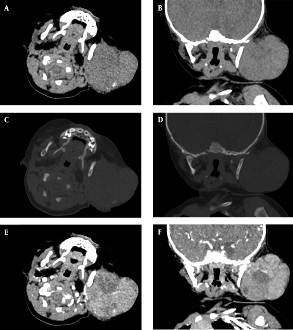 A five-month-old girl with a palpable mass on the left cheek associated with a hepatic mass. A lobulated soft tissue mass with punctate calcifications can be seen in the left cheek, A and B, Axial and coronal plain CT scans of the neck. C and D, Axial and coronal bone windows in the neck CT scans. Bone remodeling of the left ramus of the mandible can be seen; remodeling/thinning of the left maxillary and zygomatic bones is not shown; E and F, Axial and coronal contrast-enhanced CT scans show heterogeneous tumor enhancement.