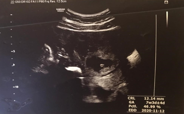 Ultrasound results showing a live embryo with the crown lump length of 12 mm and an estimated gestational age of seven weeks ± three or four days