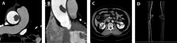 A, A 58-year-old male patient with chest tightness, lower back pain, and left lower limb pain for two hours. CTA shows local thickening of the right wall of the ascending aorta with a filling defect (approximate size, 1.2 × 1.5 cm); B, Multi-planar reconstruction indicates that the long axis of the lesion is in the direction of blood flow. The proximal segment is attached to the wall, while the distal segment is free; C, Contrast-enhanced CT cross-section shows bilateral segmental renal infarction; D, Maximum density projection of CTA for both lower limbs indicates the left popliteal artery embolism; the distal vessels are not clear.