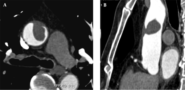 A, A 57-year-old male patient experiencing sudden chest pain for four hours while driving. CTA indicates local thickening of the anterior wall of the ascending aorta with a 3.3 × 1.7 cm filling defect. B, Multi-planar reconstruction of CTA reveals that the long axis of the lesion is in the direction of blood flow, with the proximal part attached to the vascular wall and the distal part floating free.