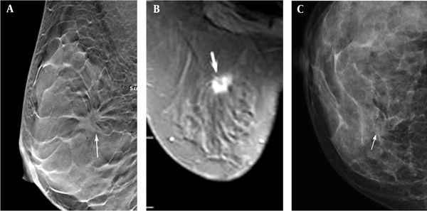 The imaging results of a 45-year-old female patient with a dense, uneven tumor (ACRc) diagnosed as stage II invasive ductal carcinoma. A, The DBT image of the largest layer indicates burrs on the edges of the mass (arrow). B, Fat-suppression T1-weighted MRI image (arrow). C, FFDM image showing overlaps between the mass edges and the mammary gland (arrow). ACR, American College of Radiology; DBT, digital breast tomosynthesis; FFDM, full-field digital mammography; MRI, magnetic resonance imaging.